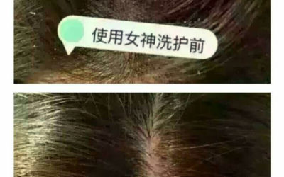 Get Rib Of Dandruff After Two Months By Using Top Team Shampoo