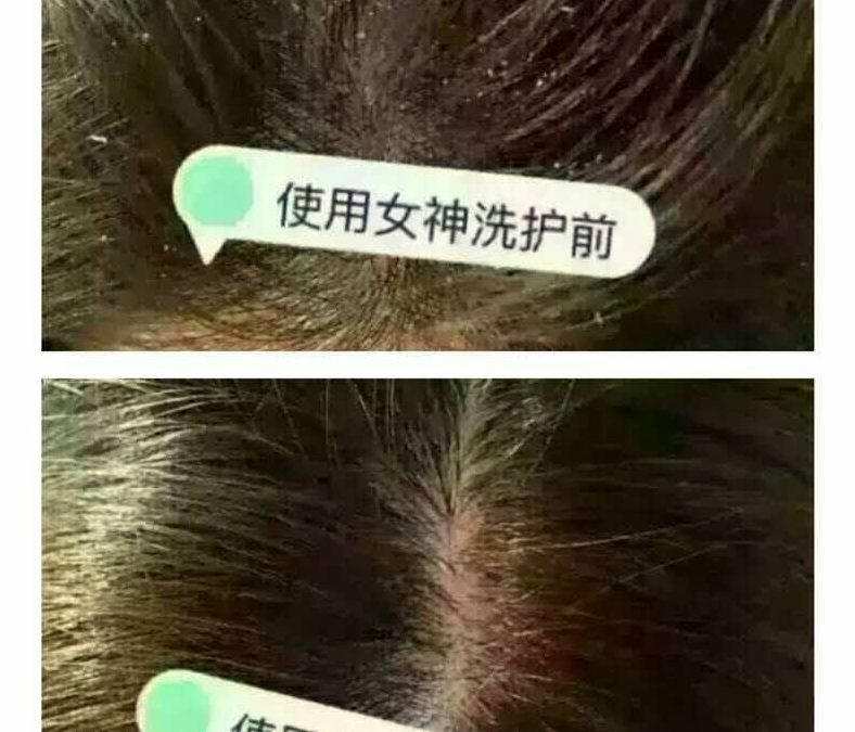 Get Rib Of Dandruff After Two Months By Using Top Team Shampoo