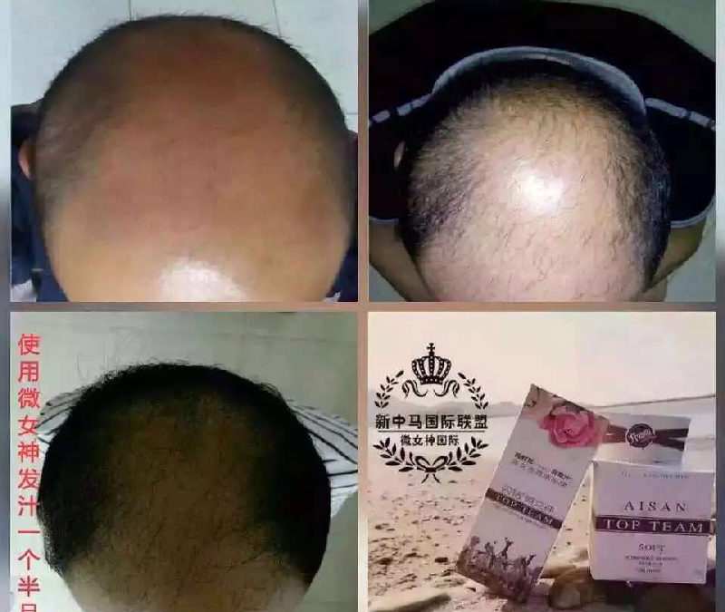 New Hair Growing After Using Top Team Hair Care Shampoo